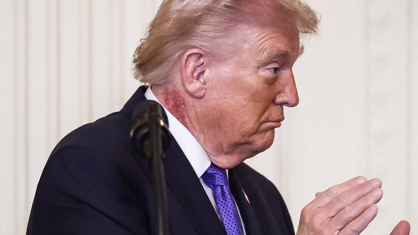 US-Präsident: Fleck am Hals befeuert Spekulationen über Trumps Gesundheit