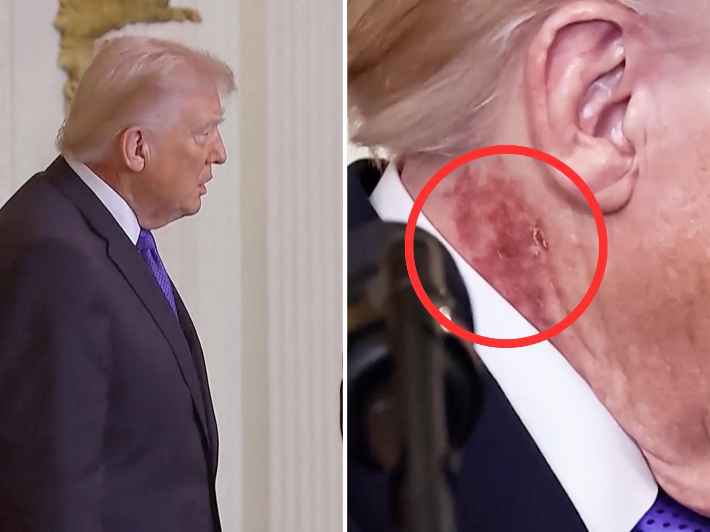 Donald Trump: Spekulationen wegen rotem Fleck an seinem Hals