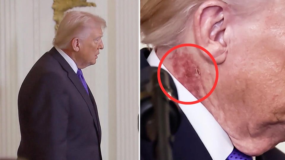 Roter Fleck an Trumps Hals - Weißes Haus äußert sich vage