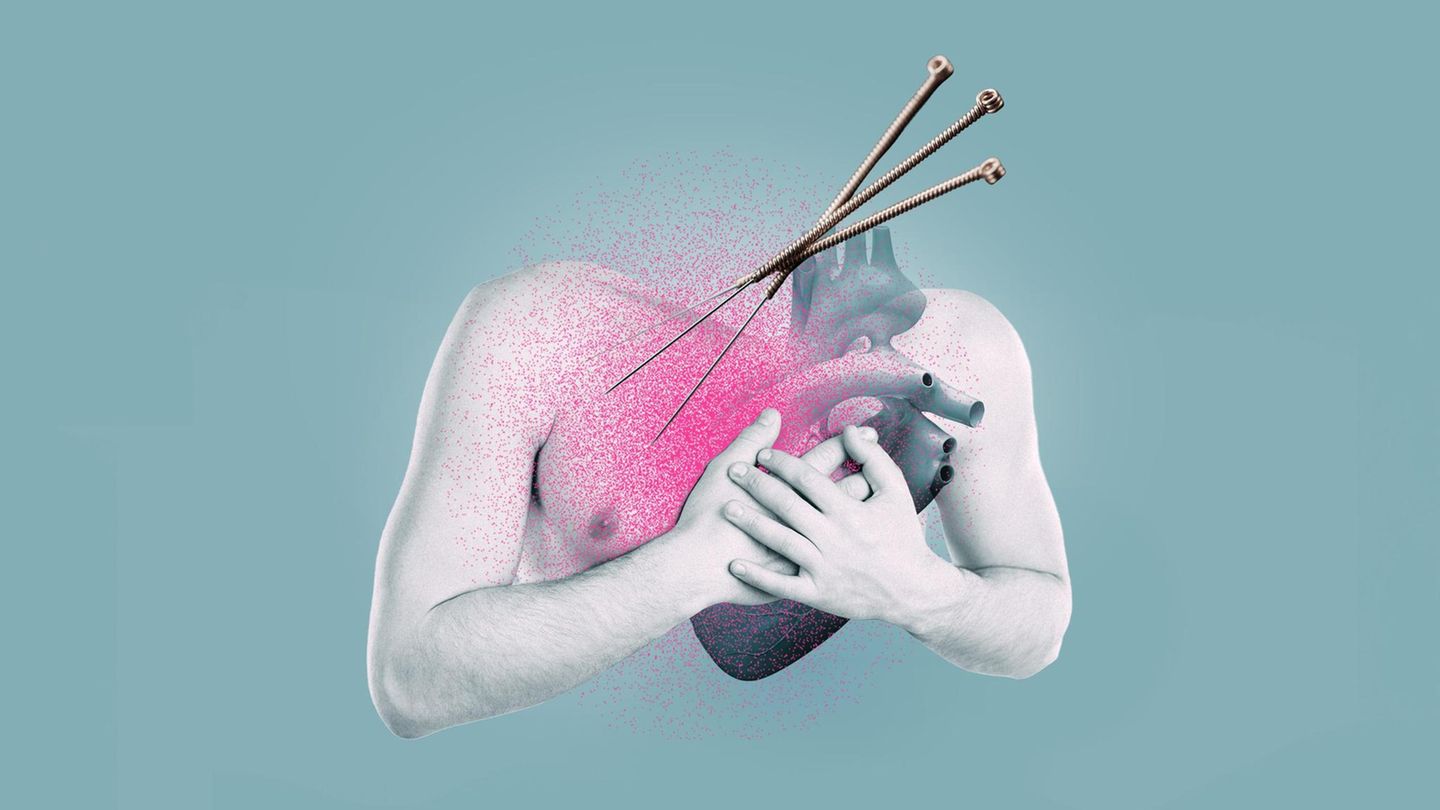 Illustration Brust, Herz und Akupunkturnadeln