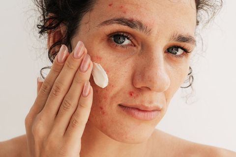 Produkte mit Azelainsäure können Akne effektiv bekämpfen.