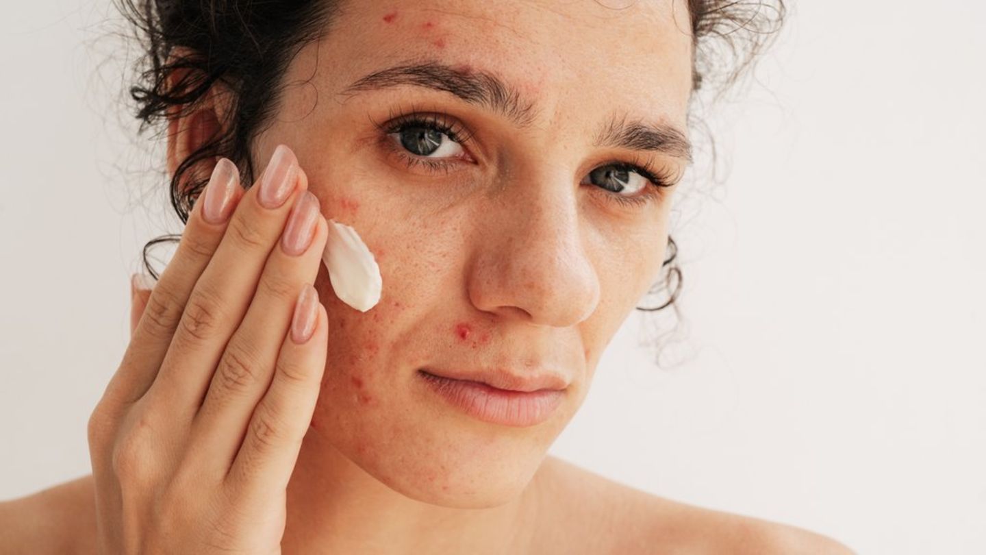 Produkte mit Azelainsäure können Akne effektiv bekämpfen.