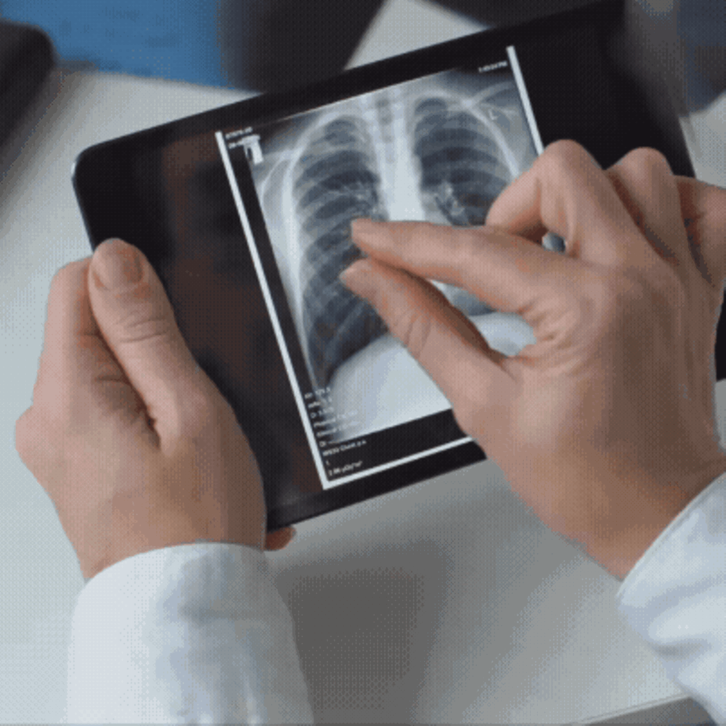 Lungenkrebs-Screening