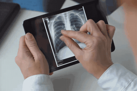 Lungenkrebs-Screening