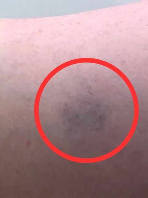 Blauer Fleck entpuppt sich plötzlich als Lebensgefahr