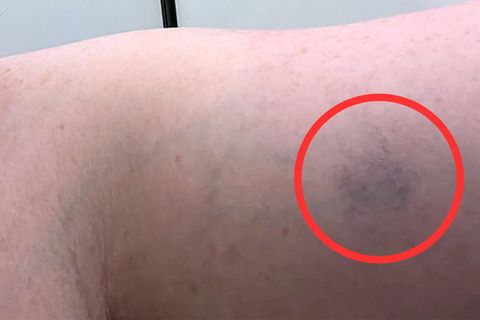 Blauer Fleck entpuppt sich plötzlich als Lebensgefahr