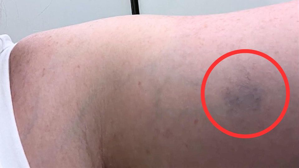 Blauer Fleck entpuppt sich plötzlich als Lebensgefahr