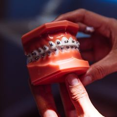 Zahnspange am Modell