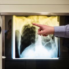 Röntgenbild Tuberkulose