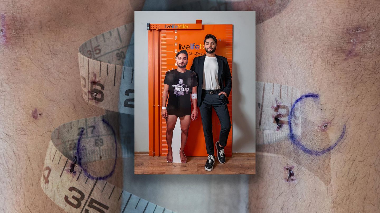 Beinverlängerung: Diese Männer fahren in eine Klinik, um sich die Beine brechen zu lassen. Warum?