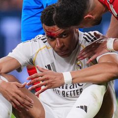 Mbappé wurde im Spiel gegen Girona im Gesicht getroffen. Foto: Manu Fernandez/AP/dpa