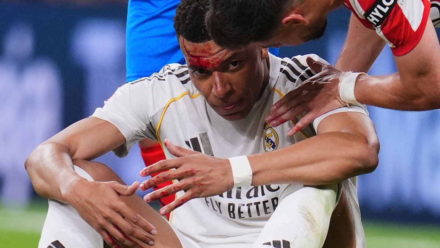 Kylian Mbappé wurde im Spiel gegen Girona im Gesicht getroffen. Foto: Manu Fernandez/AP/dpa