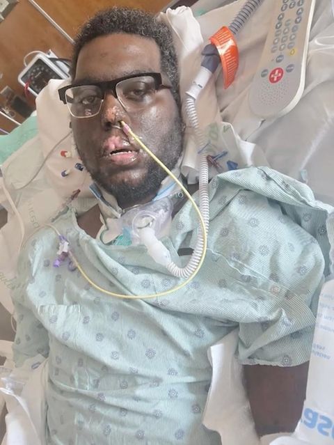 Zahnbehandlung führt zu Blutvergiftung – 34-Jähriger verliert Extremitäten