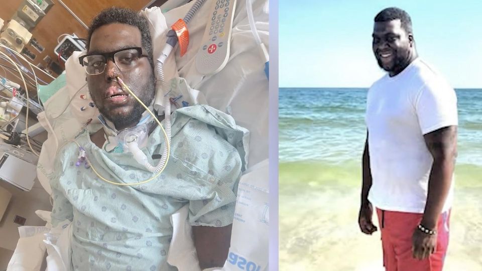 Zahnbehandlung führt zu Blutvergiftung – 34-Jähriger verliert Extremitäten