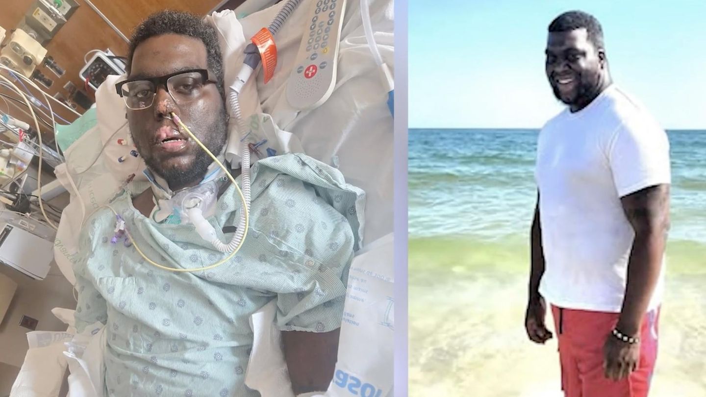 Vater von zwei Töchtern: Zahnbehandlung führt zu Blutvergiftung – 34-Jähriger verliert Extremitäten