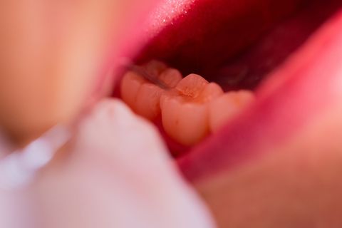 Nach einer Behandlung in einer Augsburger Zahnarztpraxis ist ein Patient gestorben. (Symbolbild) Foto: Rolf Vennenbernd/dpa