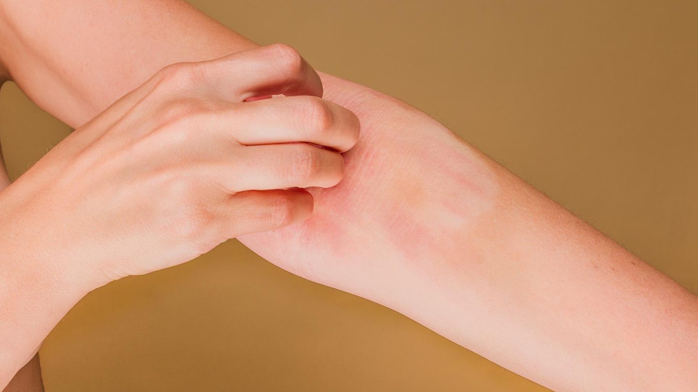 Rötung, Juckreiz, Ekzeme: „Moderne Therapeutika können Neurodermitis fast auf null reduzieren“