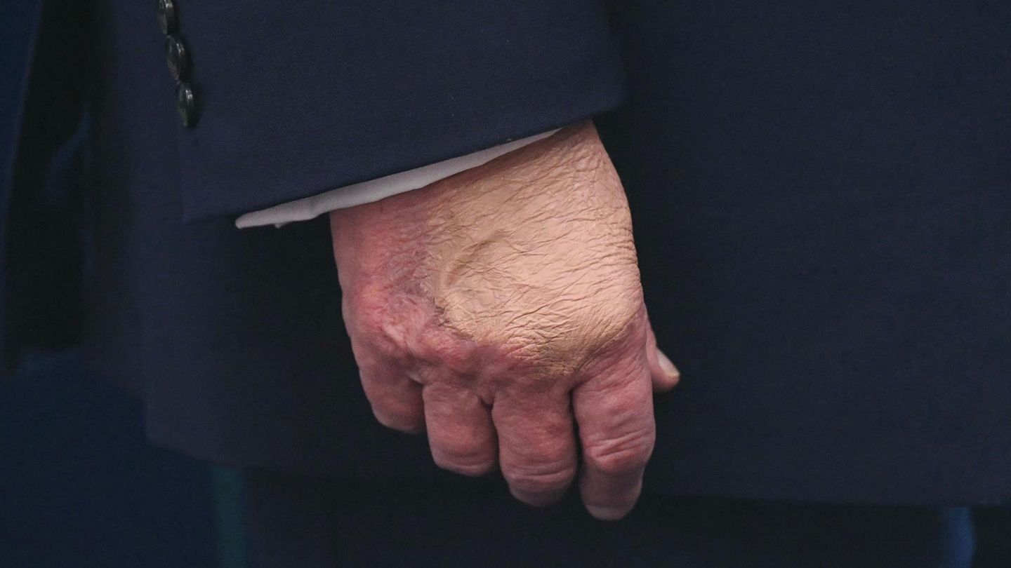 Donald Trumps überschminkter Handrücken