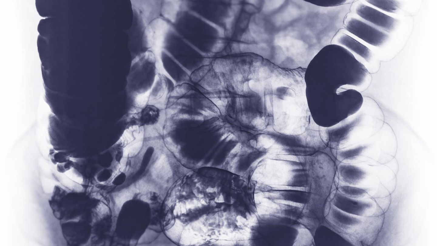 Ein Scan eines Darms