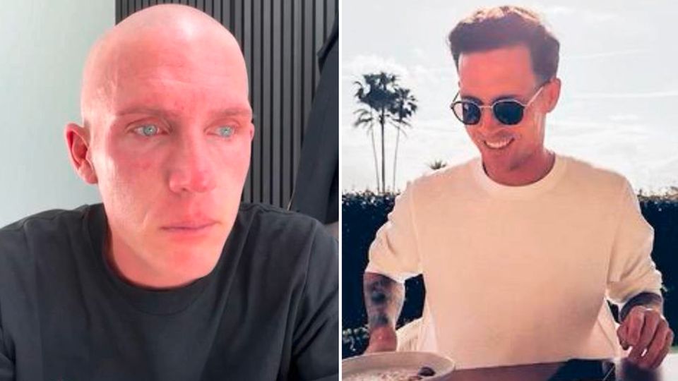 Influencer Tobias Wolf vor (l.) und nach (r.) seinem Haarverlust