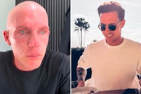 Influencer Tobias Wolf vor (l.) und nach (r.) seinem Haarverlust