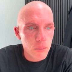Influencer Tobias Wolf vor (l.) und nach (r.) seinem Haarverlust