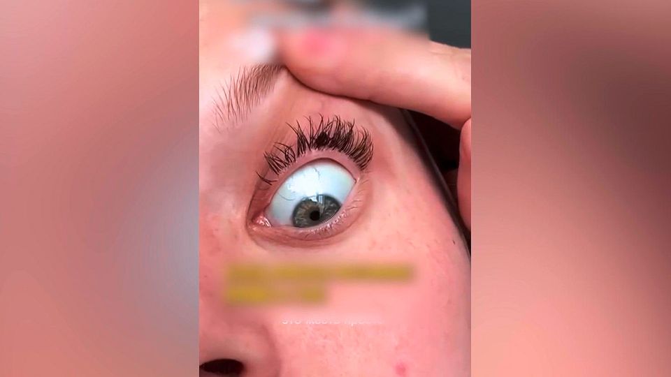 Zecke im Auge: Frau bemerkt Parasit erst nach einem Tag