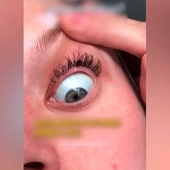 Zecke im Auge: Frau bemerkt Parasit erst nach einem Tag