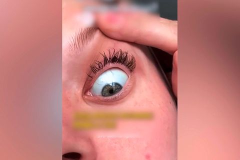 Zecke im Auge: Frau bemerkt Parasit erst nach einem Tag