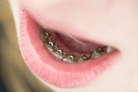 In Thüringen versorgen derzeit etwa 90 Praxen ohne Fachzahnarzt-Titel für Kieferorthopädie etwa 11.300 Kinder und Jugendliche. (