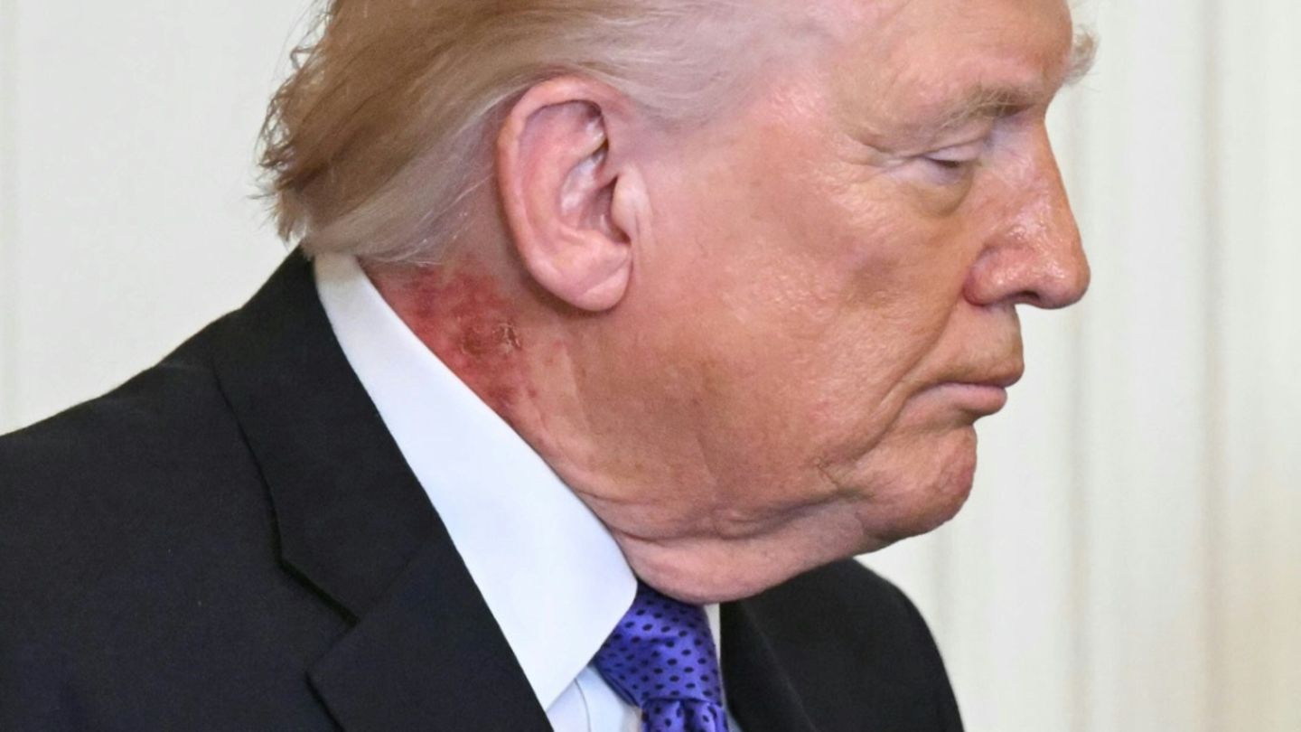 Roter Ausschlag am Hals von US-Präsident Donald Trump
