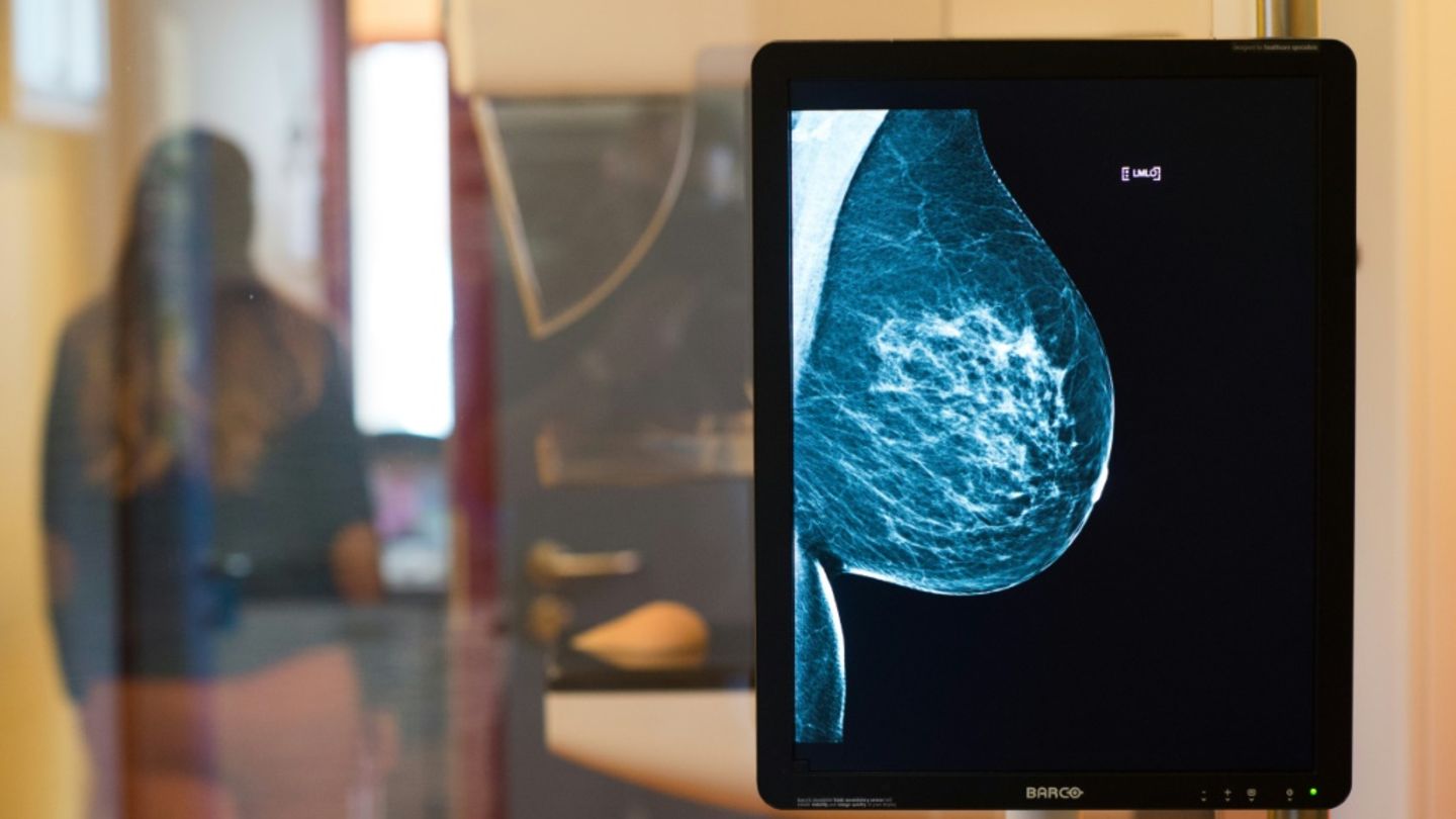 Mammografie: Altersgrenze für Brustkrebs-Früherkennung wird herabgesetzt