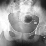 Schmerzhaft: Hier hat sich ein Ei im Darm des Patienten verhakt. Dieser hatte es zur sexuellen Stimulation eingeführt. Auf dem Röntgenbild wird sichtbar, wie weit das Ei im Körper steckt.