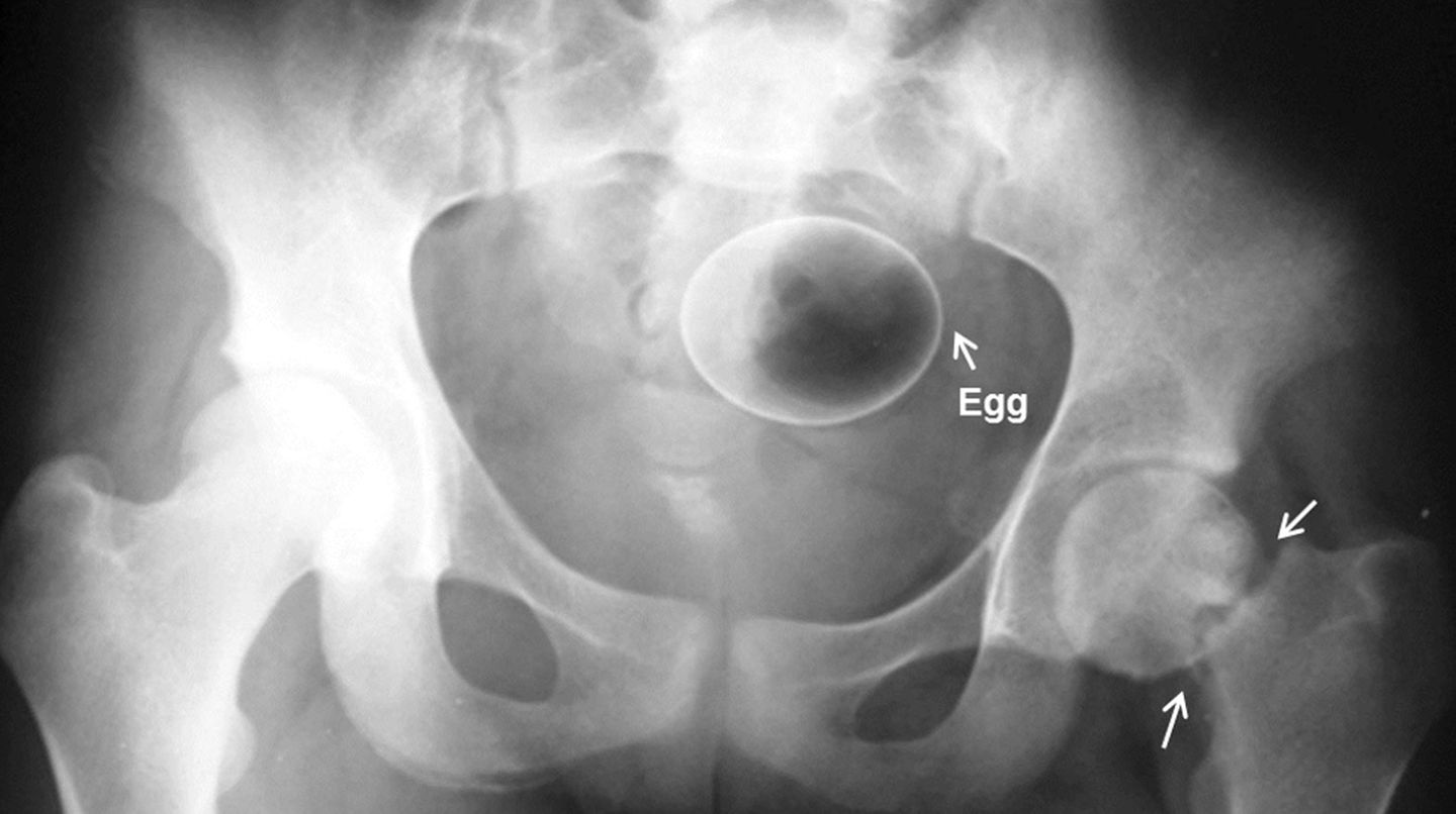 Schmerzhaft: Hier hat sich ein Ei im Darm des Patienten verhakt. Dieser hatte es zur sexuellen Stimulation eingeführt. Auf dem Röntgenbild wird sichtbar, wie weit das Ei im Körper steckt.