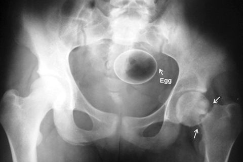 Schmerzhaft: Hier hat sich ein Ei im Darm des Patienten verhakt. Dieser hatte es zur sexuellen Stimulation eingeführt. Auf dem Röntgenbild wird sichtbar, wie weit das Ei im Körper steckt.