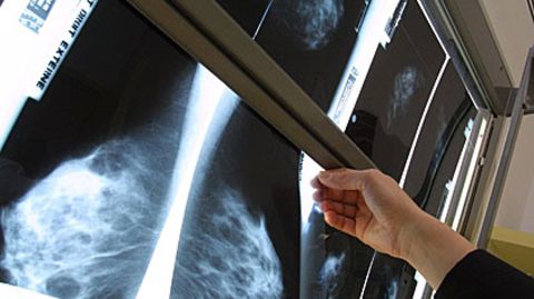 Der Abwärtstrend beruht auf besseren Heilungschancen: Auch an Brustkrebs sterben weniger Frauen