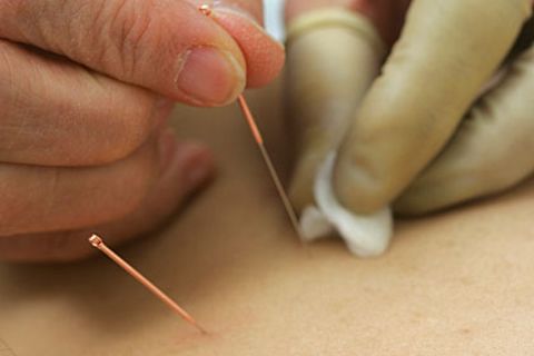 In Essen werden die Krebspatienten ergänzend zur traditionellen Therapie auch mit Akupunktur behandelt