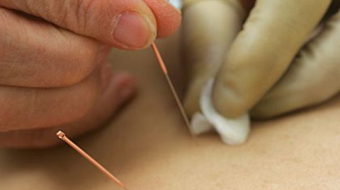 In Essen werden die Krebspatienten ergänzend zur traditionellen Therapie auch mit Akupunktur behandelt