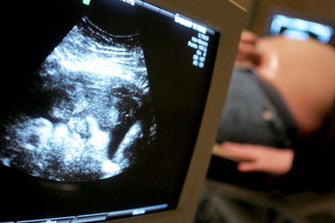 Die Zahl der Abtreibungen sinkt in Deutschland seit dem Jahr 2005