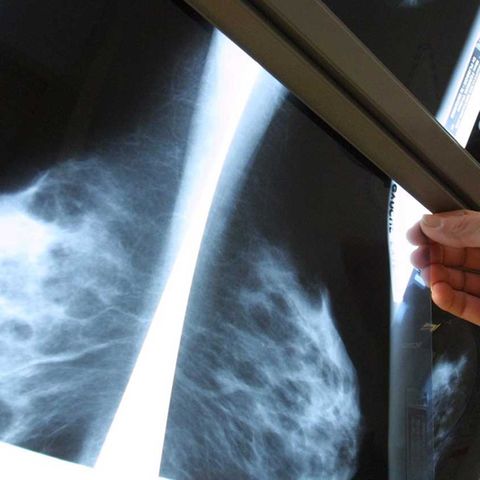 Die Mammografie ist das wichtigste bildgebende Verfahren zur Früherkennung kleiner Brusttumore.