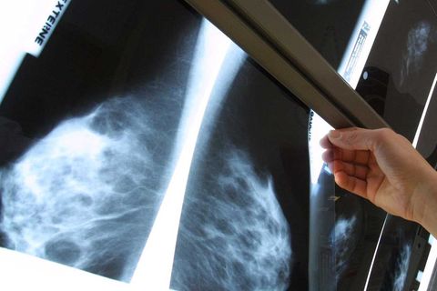 Die Mammografie ist das wichtigste bildgebende Verfahren zur Früherkennung kleiner Brusttumore.