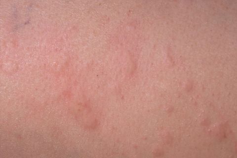 Ein typisches Symptom bei Nesselsucht ist der juckende Hautausschlag