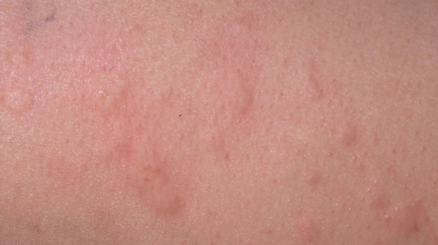 Ein typisches Symptom bei Nesselsucht ist der juckende Hautausschlag