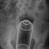 Dieser Patient führte sich eine Spraydose ein.