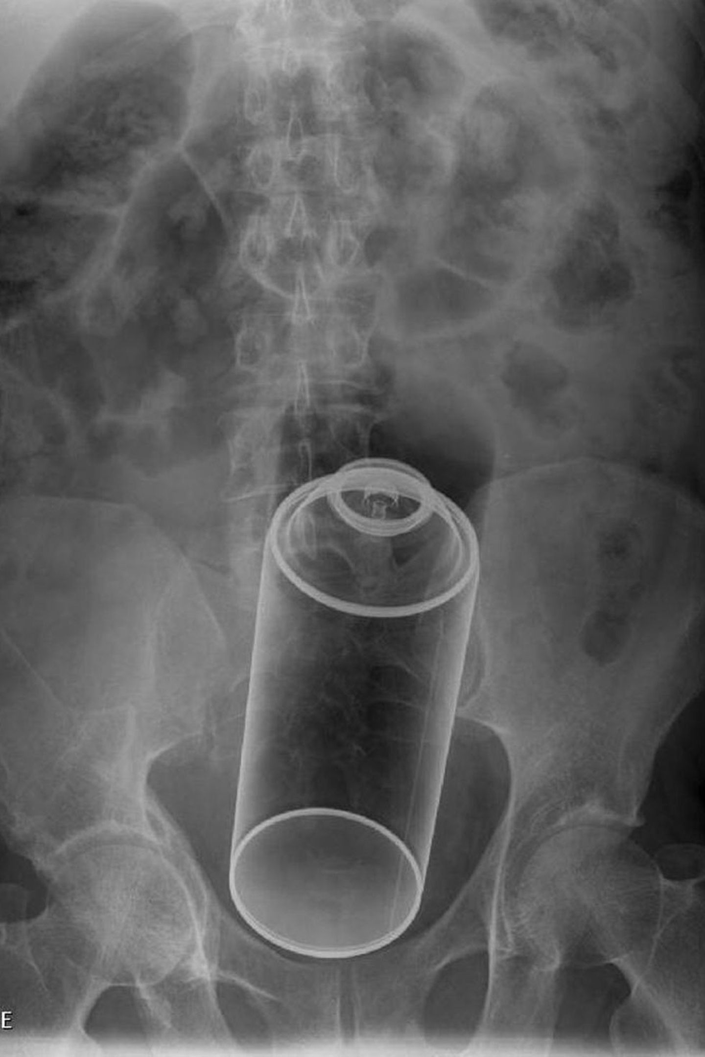 Dieser Patient führte sich eine Spraydose ein.