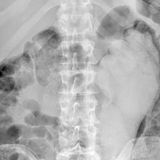 Keine Eisenfaust, aber eine Gummihand.