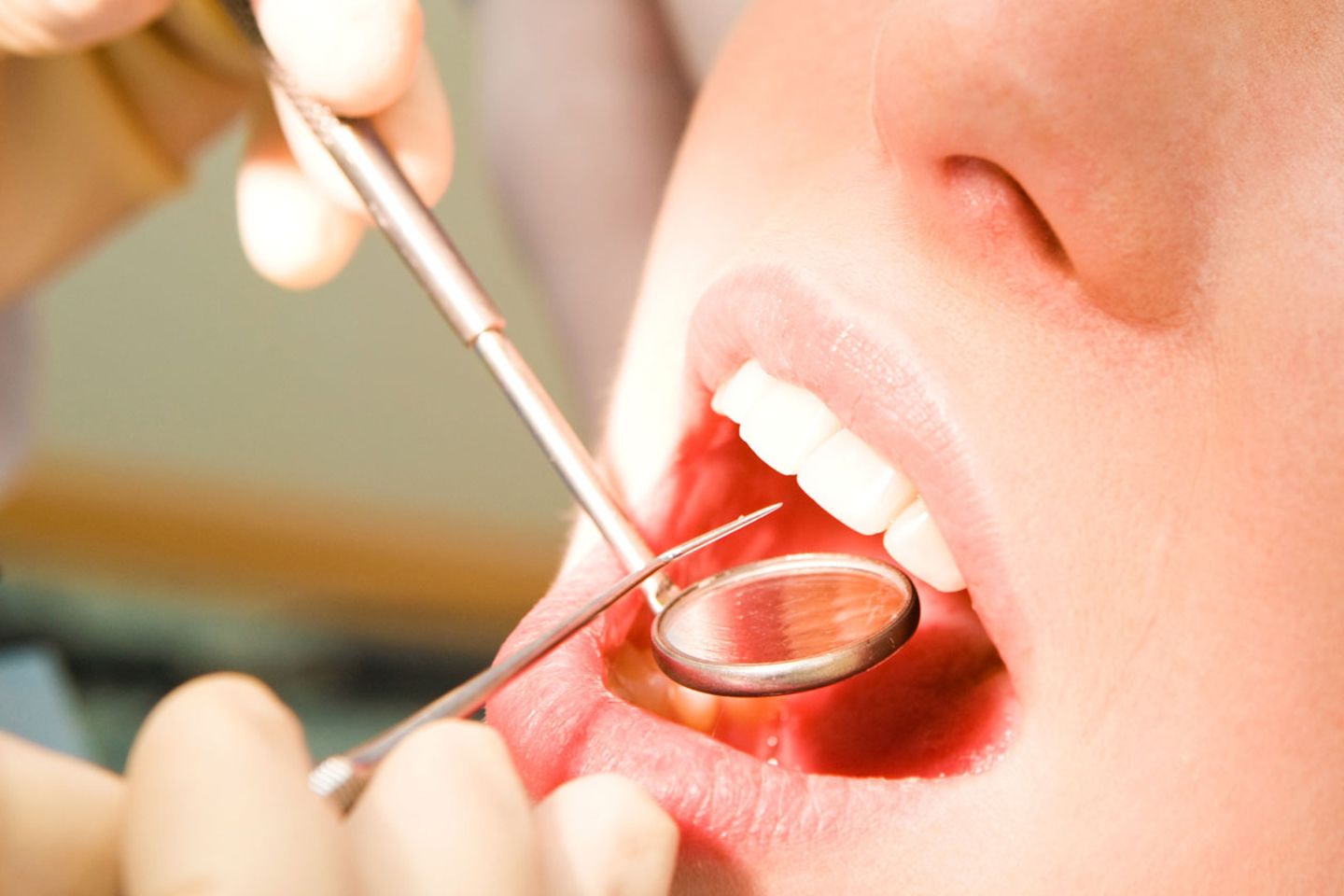 Mit Kratzern und Schabern werden Ihre Zähne vom Zahnstein befreit