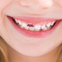 Kinder bemerken es nicht gleich, wenn sie Karies haben