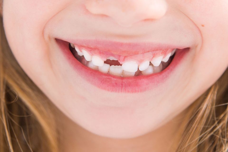 Zahnkrankheiten bei Kindern Mama, mein Mund tut weh! STERN.de
