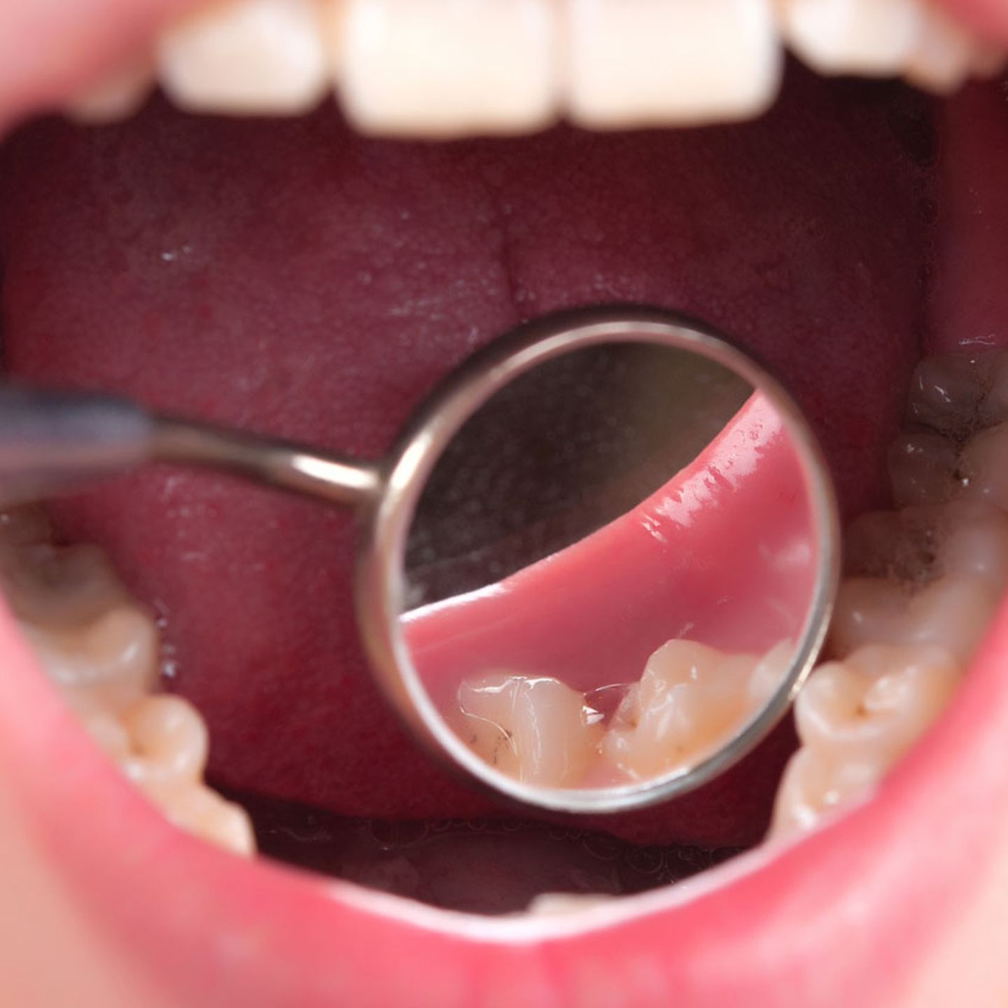 Verfärbung zahn graue Gerade Zähne